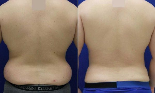 اضرار شفط الدهون من الظهر
