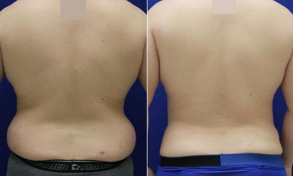 اضرار شفط الدهون من الظهر