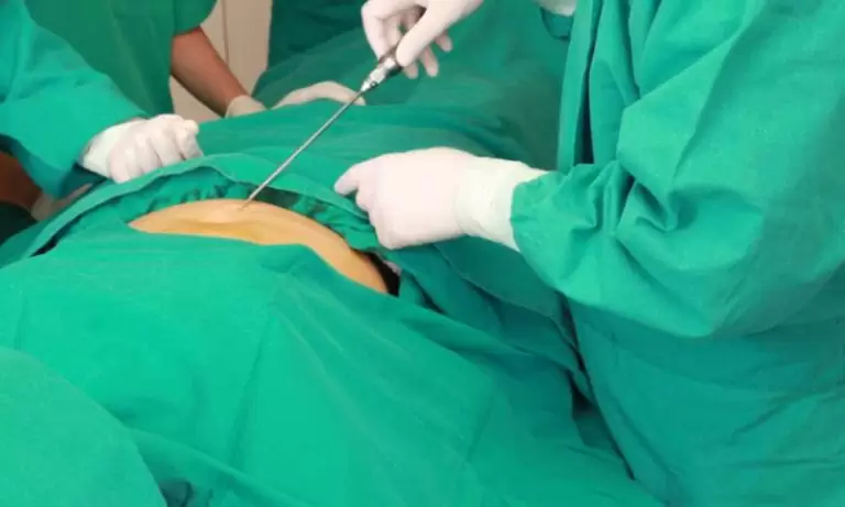 تقنية الفيزر لشفط الدهون