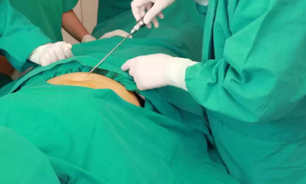 تقنية الفيزر لشفط الدهون