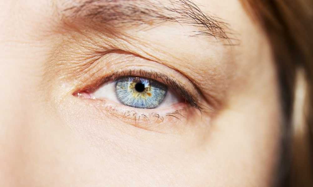 علاج ترهل الجفون