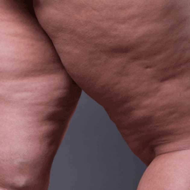 علاج التصاق الفخذين بالفيزر
