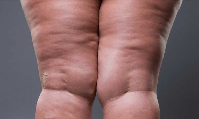 علاج التصاق الفخذين بالفيزر