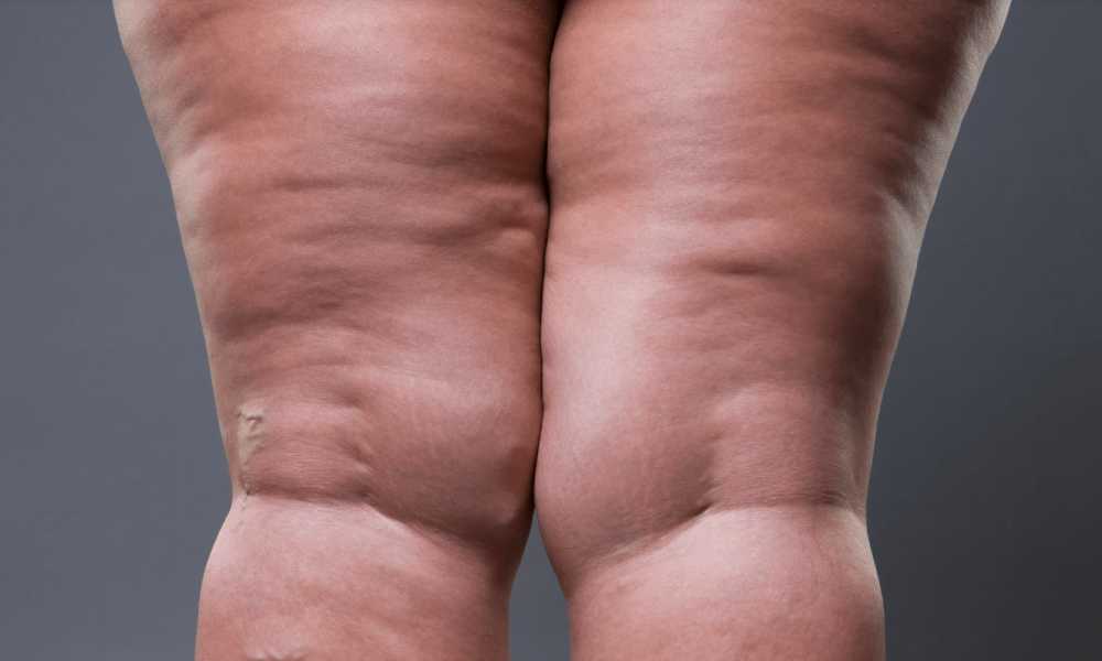 علاج التصاق الفخذين بالفيزر