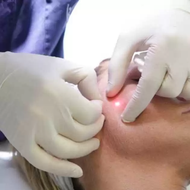 endolift