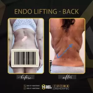 اندولفت endolift