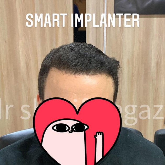 نتائج زراعة الشعر بالأقلام الذكية