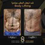 شد البطن بالجراحة
