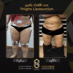 شفط دهون الأفخاذ