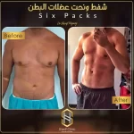 شفط دهون البطن