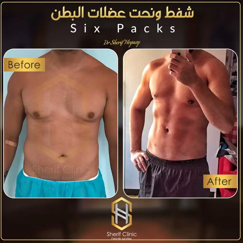 شفط دهون البطن