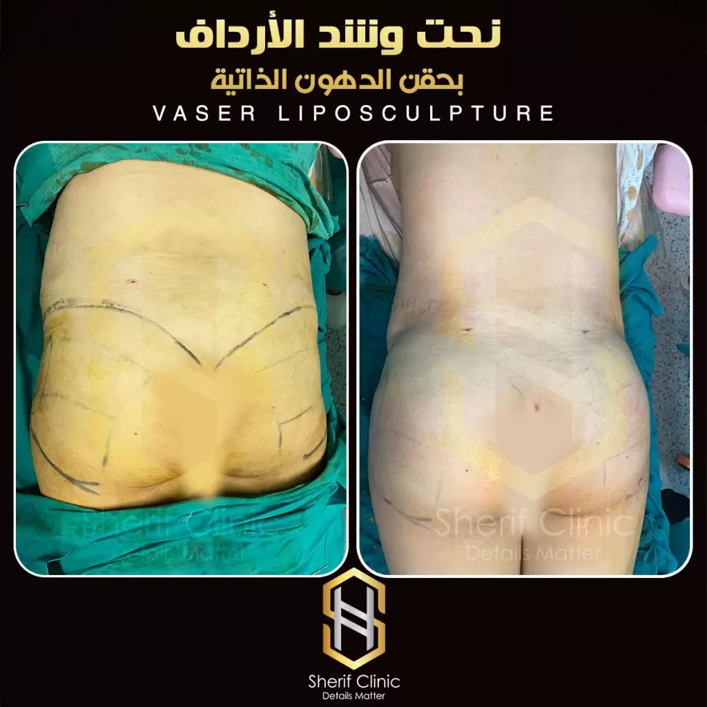 نحت الأرداف