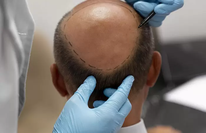 اسعار زراعة الشعر