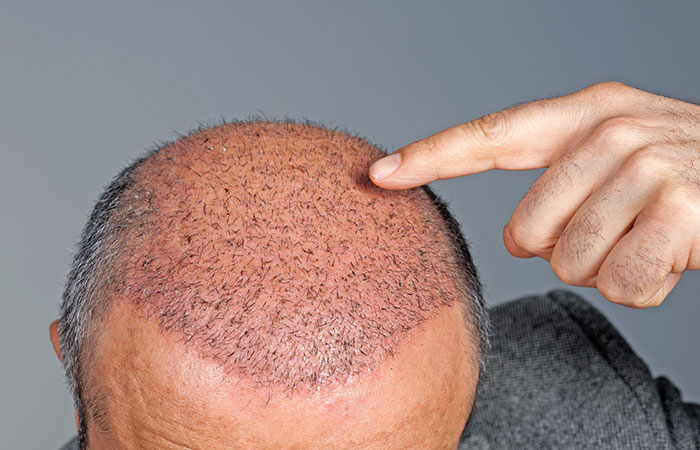 بديل زراعة الشعر