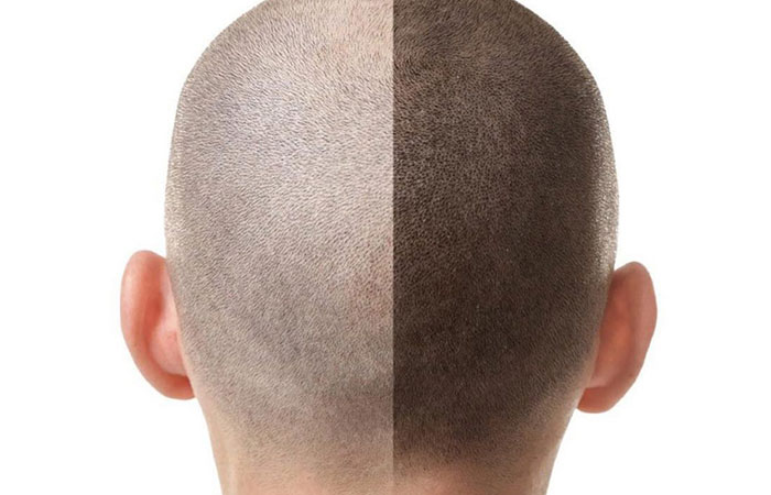 تجربتي مع زراعة الشعر