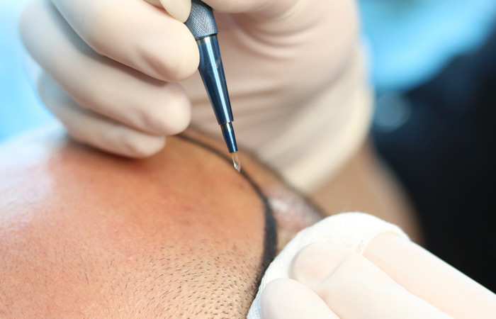 تقنية السفير لزراعة الشعر