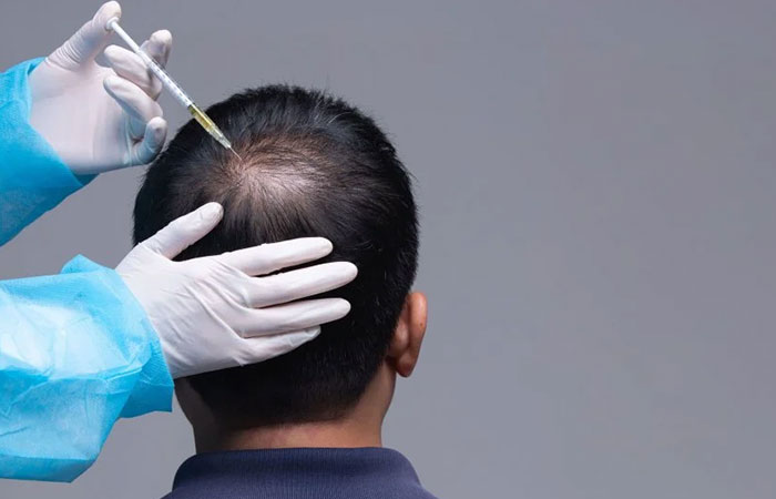 زراعة الشعر بالخلايا الجذعية