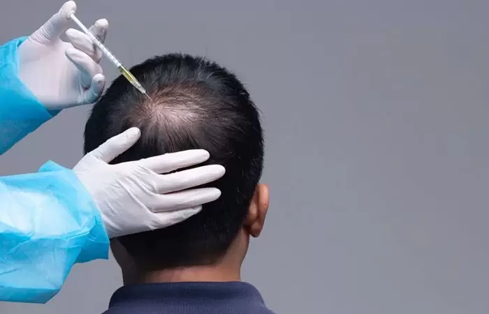 زراعة الشعر بالخلايا الجذعية