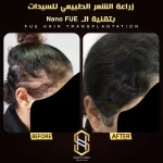 زراعة الشعر قبل وبعد للسيدات