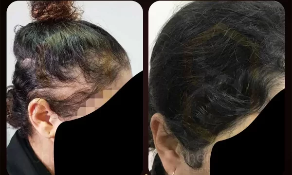 زراعة الشعر قبل وبعد للسيدات