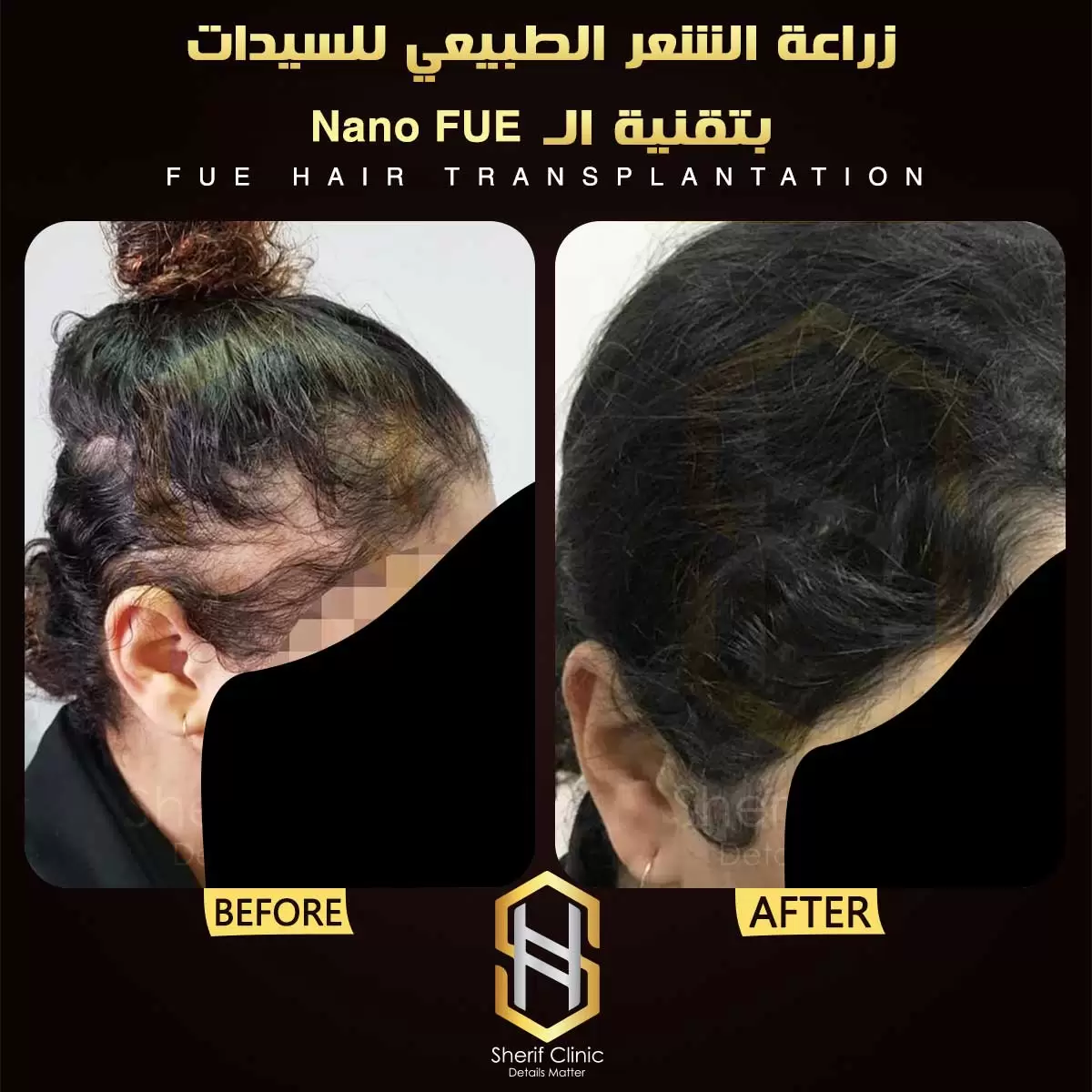 زراعة الشعر قبل وبعد للسيدات