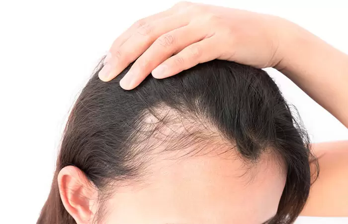 زراعة الشعر للنساء