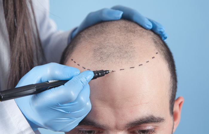 زراعة الشعر
