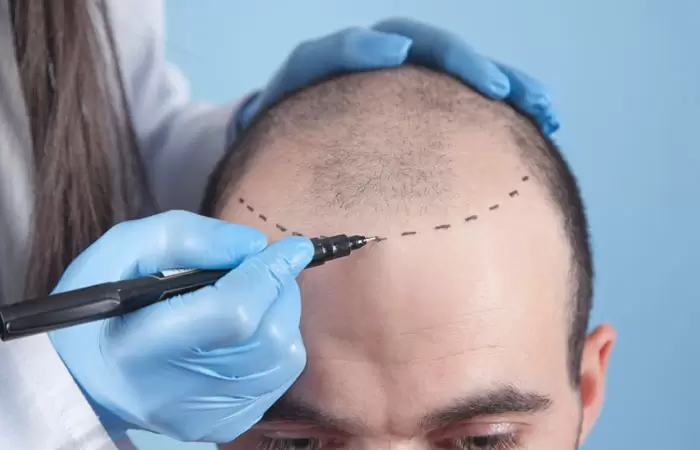 زراعة الشعر