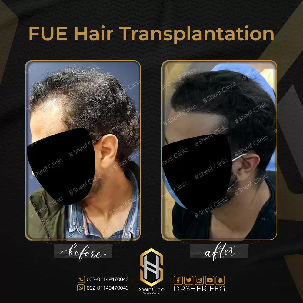 بعد ظهور نتائج زراعة الشعر