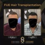 نتائج زراعة الشعر قبل وبعد للرجال