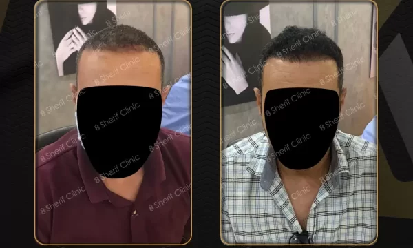 نتائج زراعة الشعر قبل وبعد للرجال
