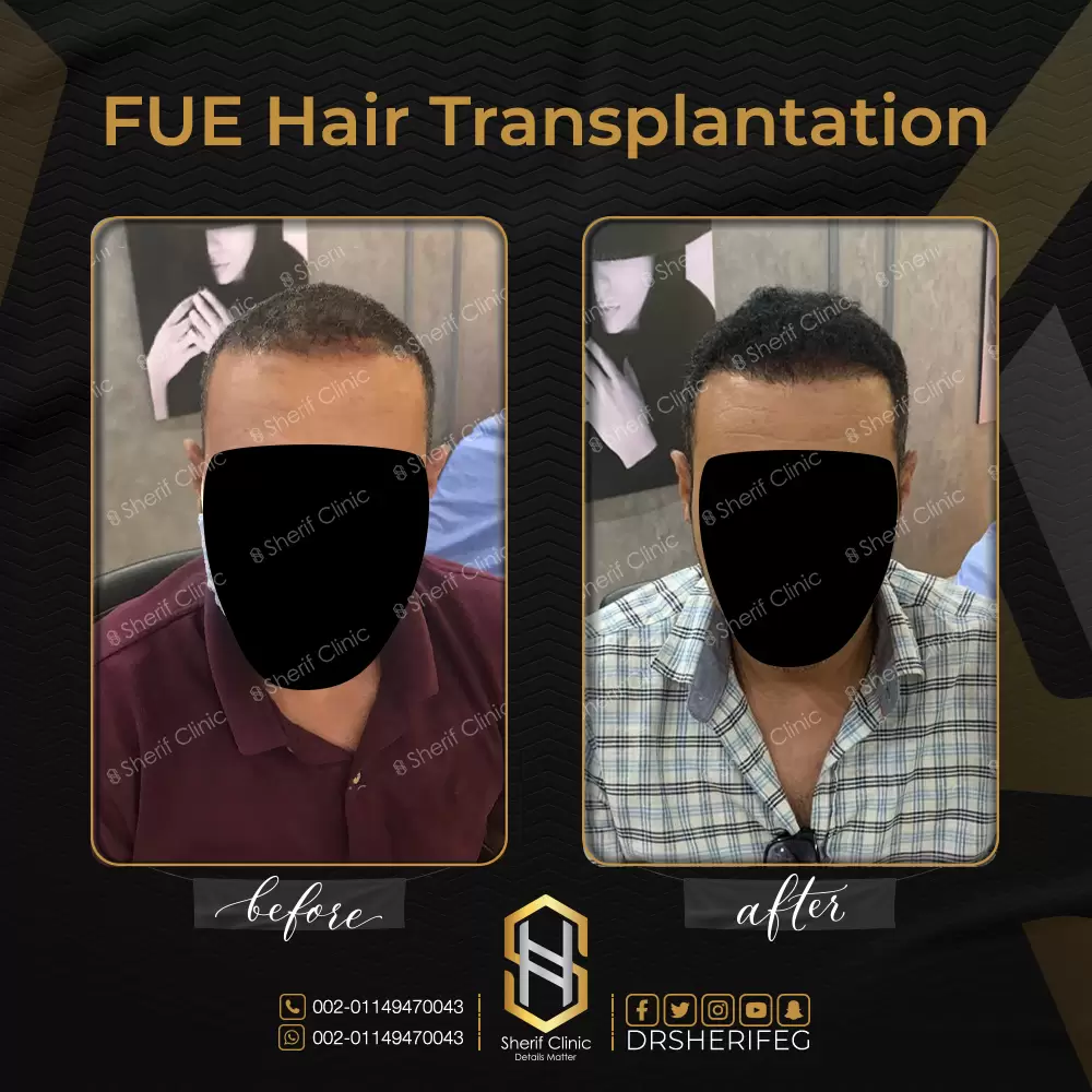 نتائج زراعة الشعر قبل وبعد للرجال