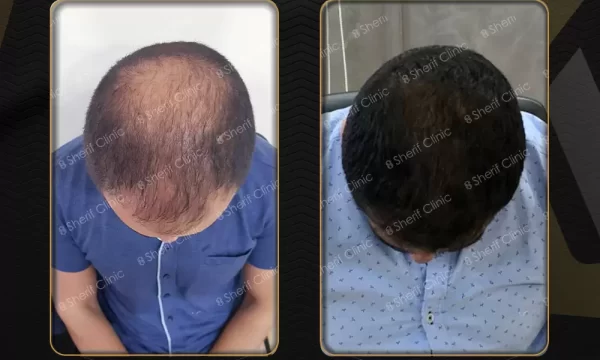 قبل وبعد زراعة الشعر بالاقتطاف