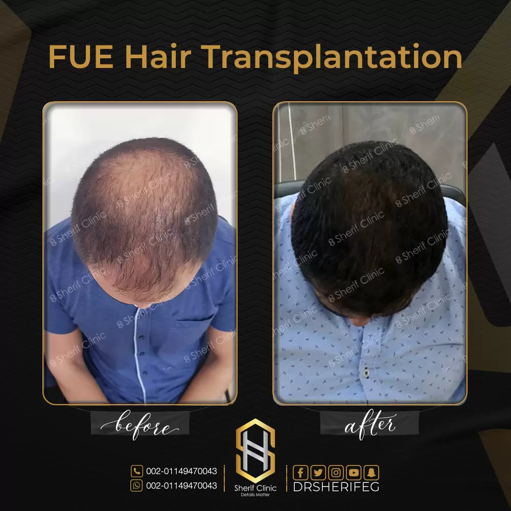 قبل وبعد زراعة الشعر بالاقتطاف