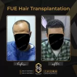 زراعة الشعر قبل وبعد