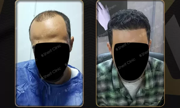 زراعة الشعر قبل وبعد