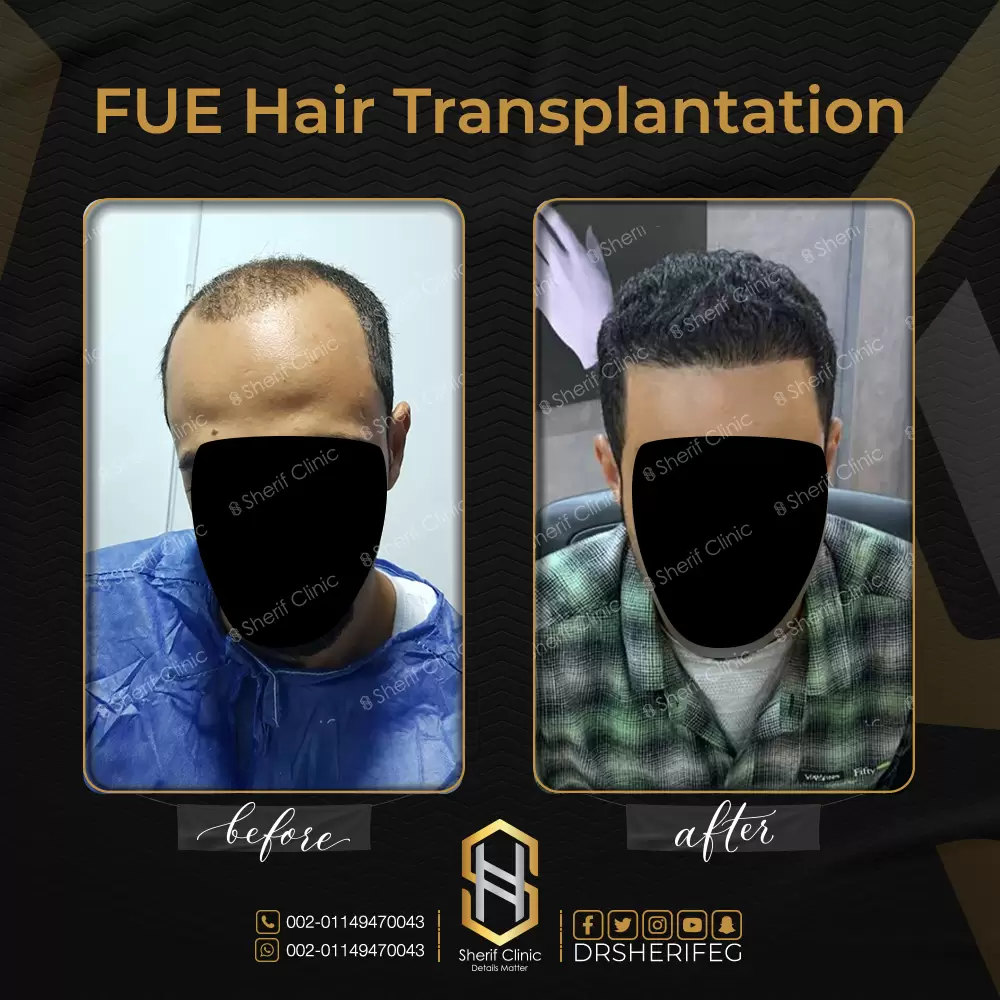 زراعة الشعر قبل وبعد