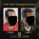 قبل وبعد زرع الشعر للرجال