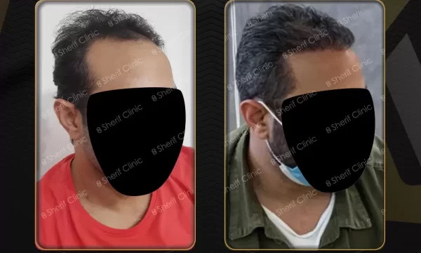 قبل وبعد زرع الشعر للرجال