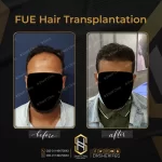 نتائج زراعة الشعر للرجال