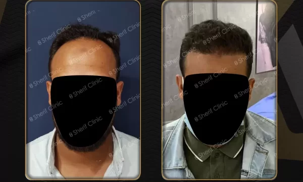 نتائج زراعة الشعر للرجال