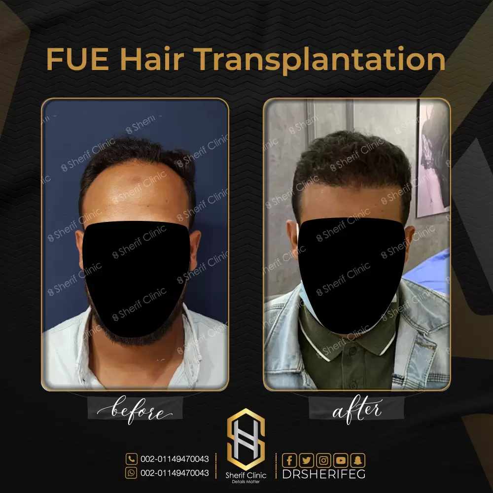 نتائج زراعة الشعر للرجال