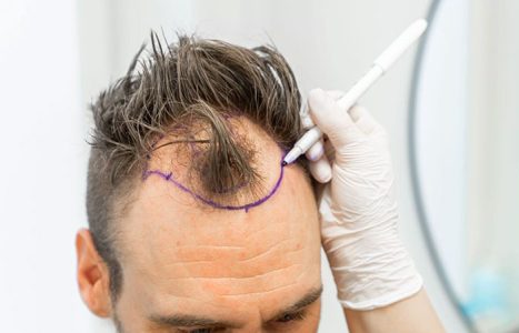 سعر زراعة الشعر