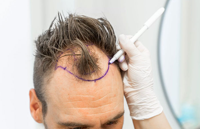 سعر زراعة الشعر