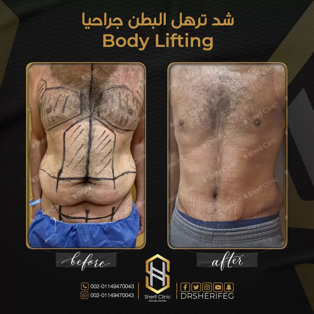 شد الترهلات للرجال