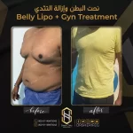شفط الدهون للرجال