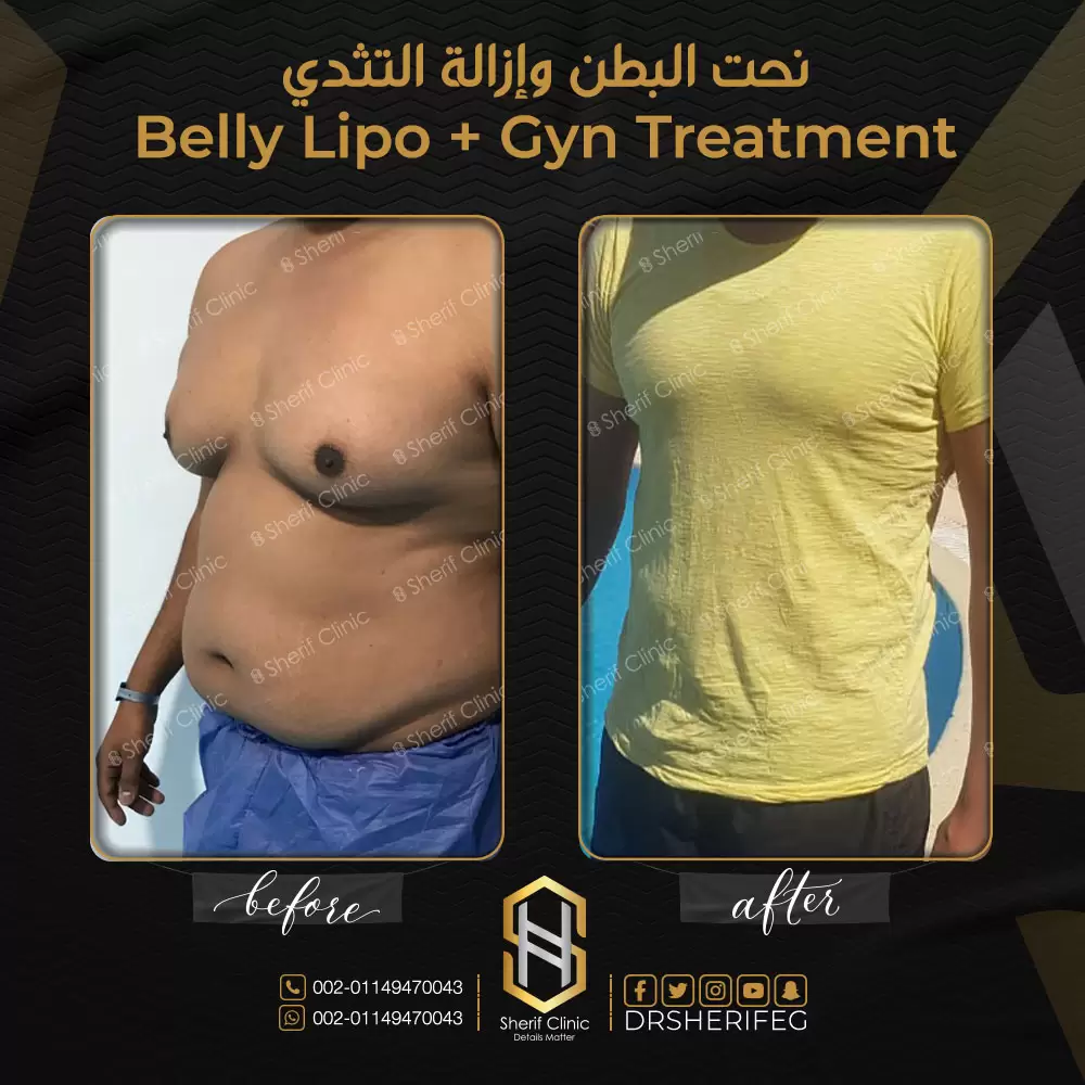 شفط الدهون للرجال
