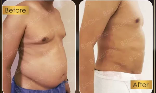 شفط ونحت البطن والأجناب بالفيزر