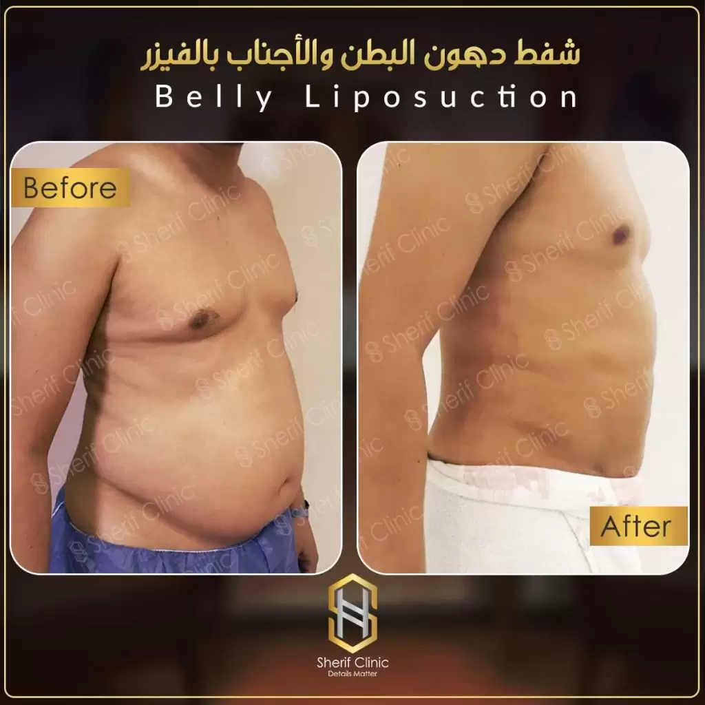شفط ونحت البطن والأجناب بالفيزر