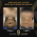 شفط ونحت دهون الجسم بالفيزر